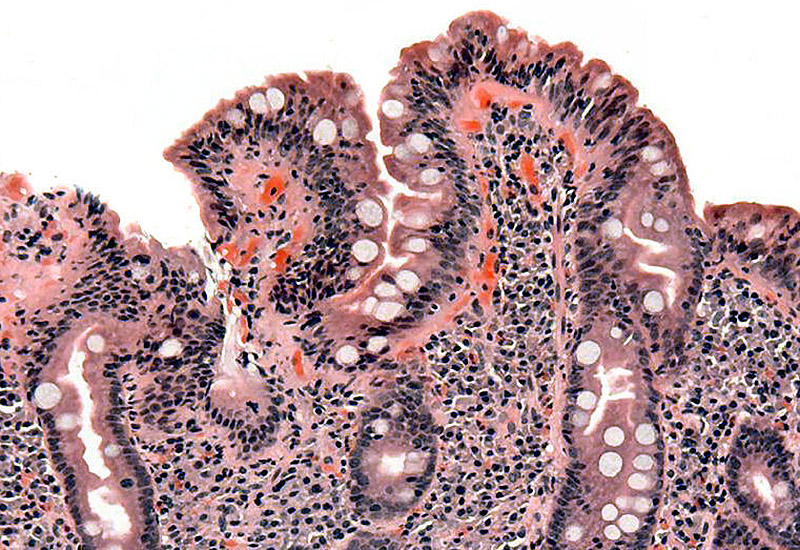 Biopsia de un intestino delgado en el que se aprecian lesiones causadas por la celiaquía.